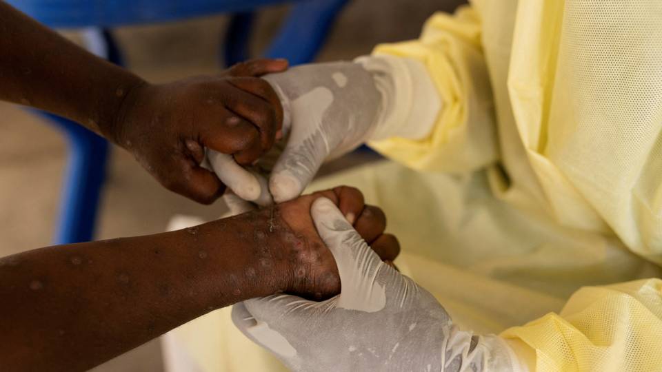 Mpox spread: Why the strategy that eliminated Ebola is worth replicating